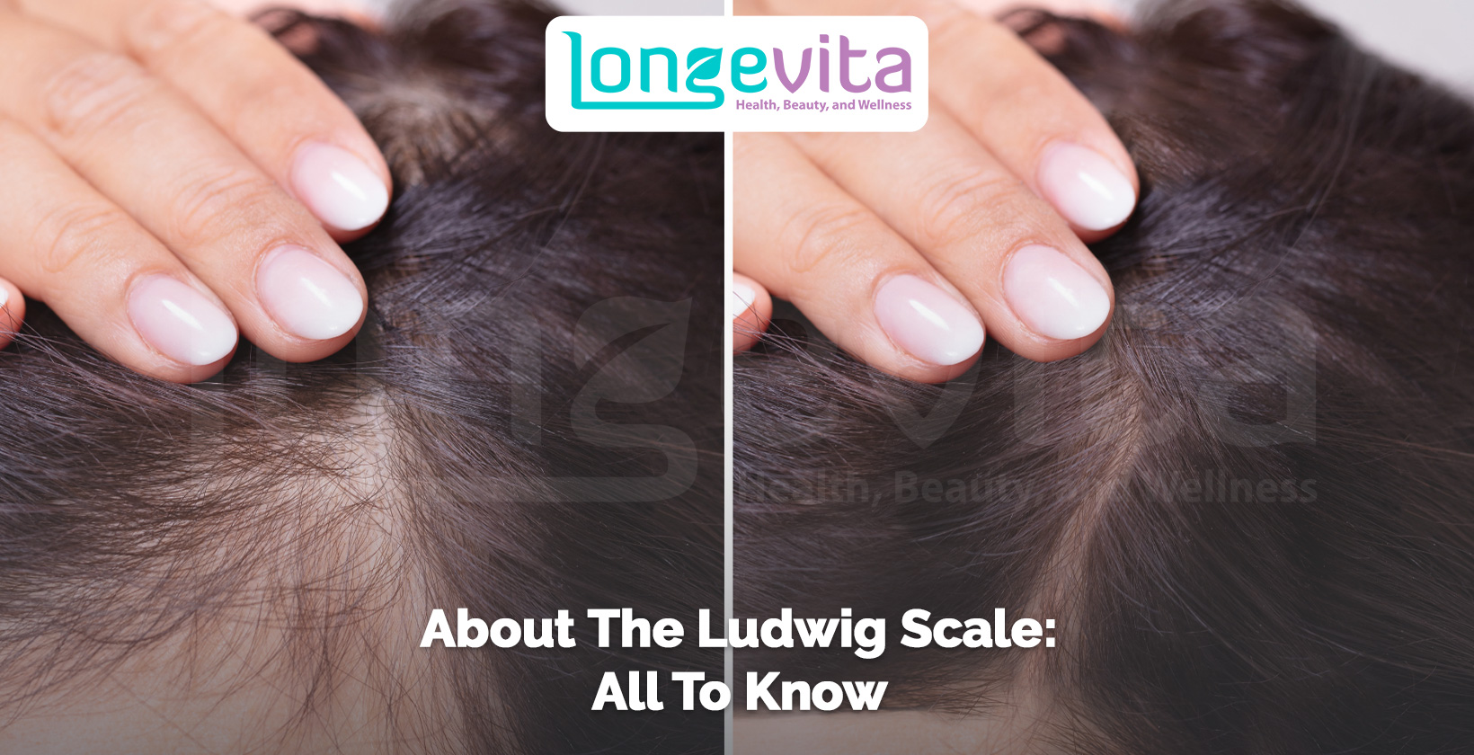 close-up of a woman’s scalp showing hair thinning with text about the ludwig scale