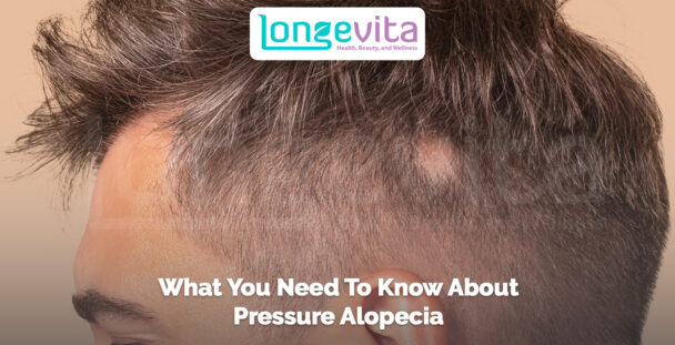 side view of a man’s head showing patchy hair thinning with text about pressure alopecia