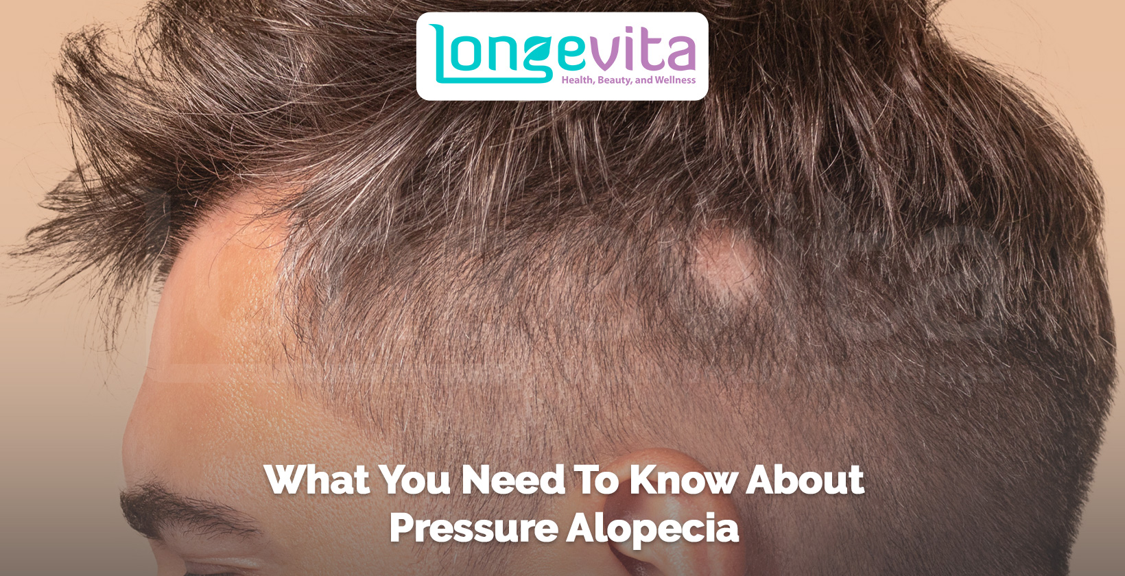 side view of a man’s head showing patchy hair thinning with text about pressure alopecia