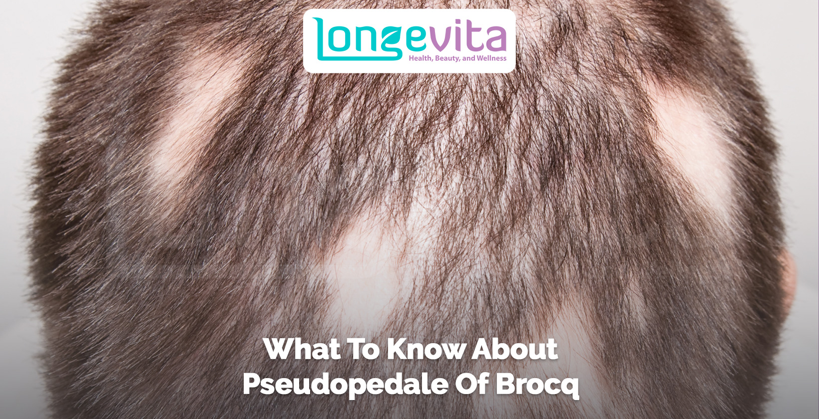 scalp with patchy bald spots and text about pseudopelade of brocq