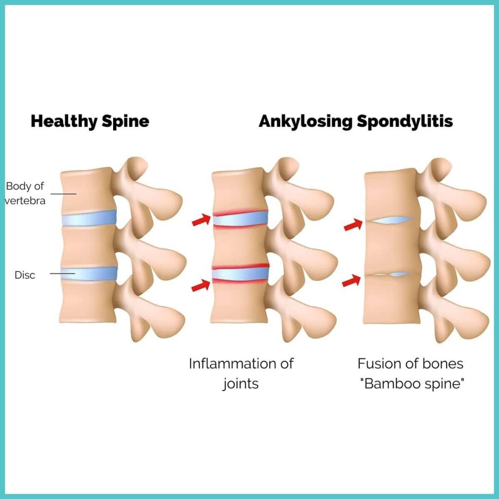 Ankylosing spondylitis spine
