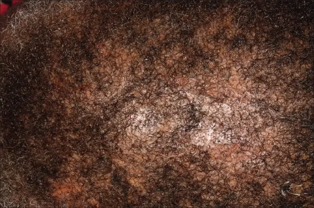 Central Centrifugal Cicatricial Alopecia 2