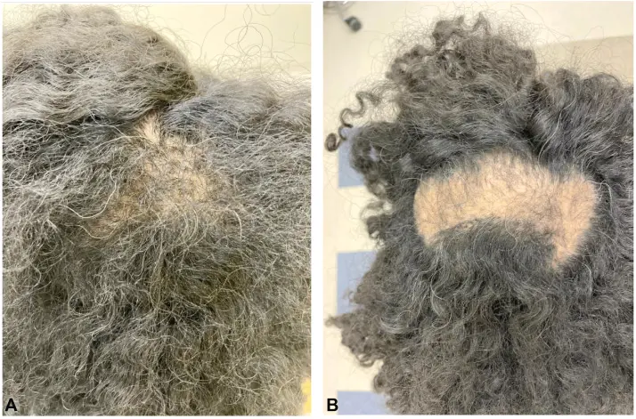 Central Centrifugal Cicatricial Alopecia