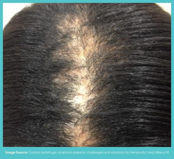 Central centrifugal cicatricial alopecia
