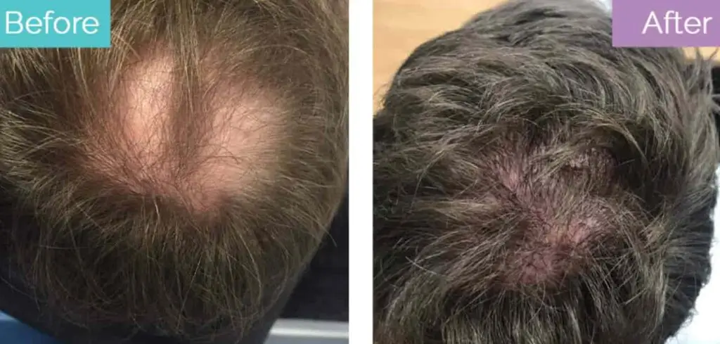 Crown hair loss