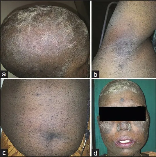 Graham Little Piccardi Lasseur Syndrome