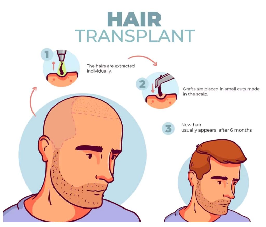 How a hair transplant works