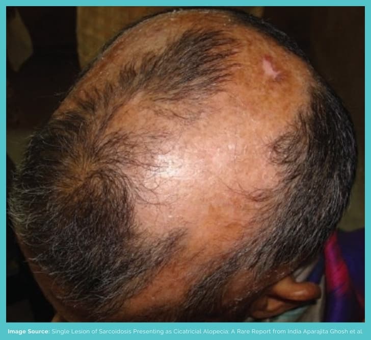 Sarcoidiosis hair loss