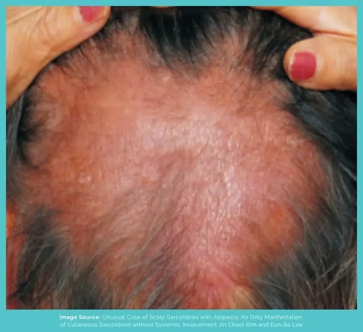 Sarcoidosis hair loss patch