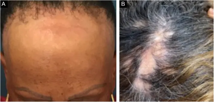 scarring alopecia