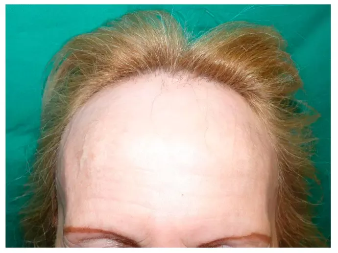 Frontal Fibrosing Alopecia