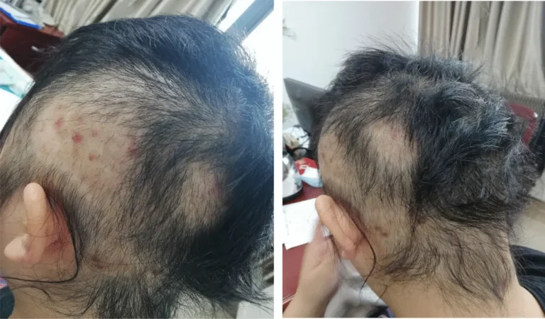 Trichotillomania 2