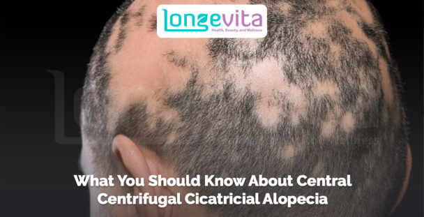 scalp with patchy hair loss caused by central centrifugal cicatricial alopecia