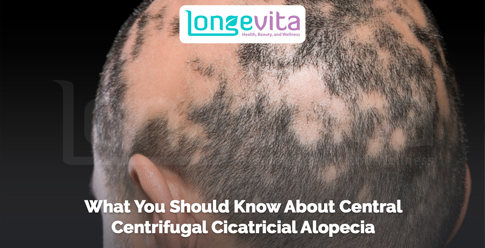 scalp with patchy hair loss caused by central centrifugal cicatricial alopecia
