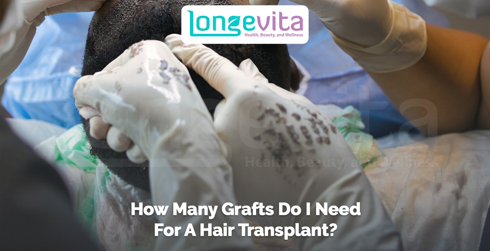 surgeon performing hair transplant on patient’s scalp wearing surgical gloves