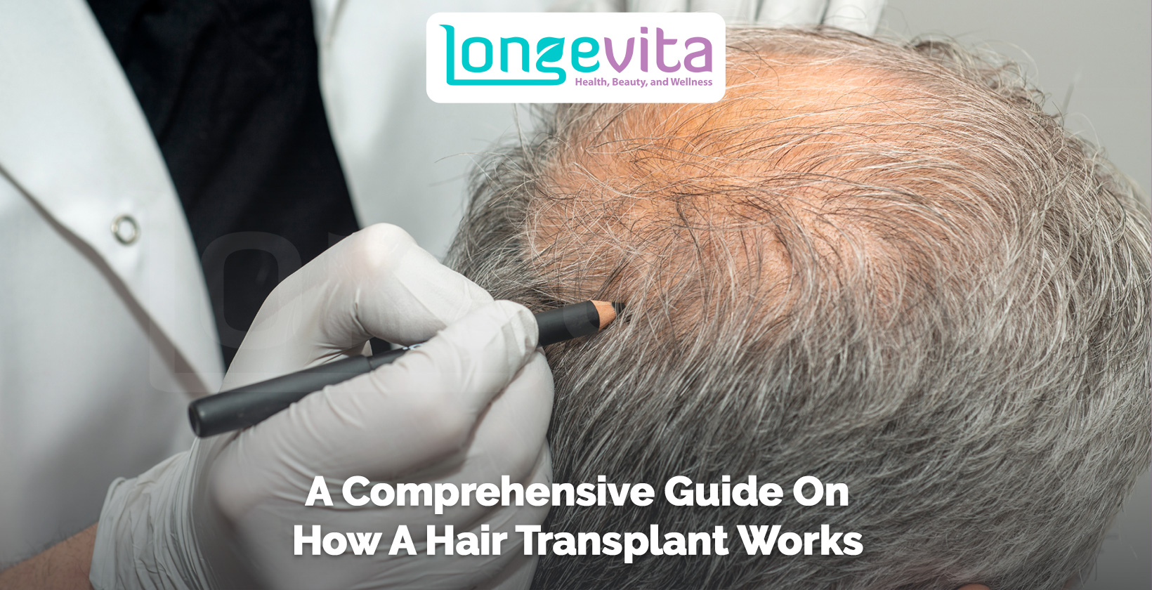doctor marking bald area on patient’s scalp with a pen before hair transplant
