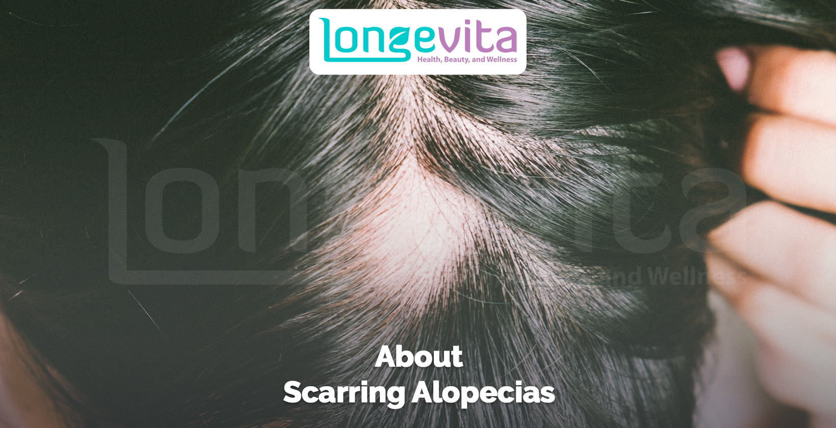 close-up of scalp with a bald patch caused by scarring alopecia