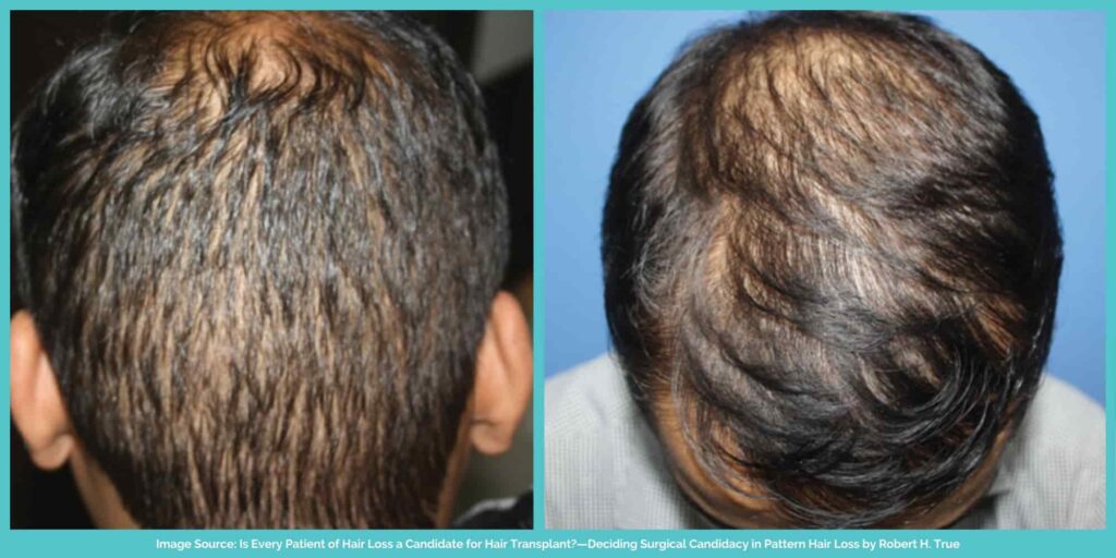 Patterned and unpatterned hair loss