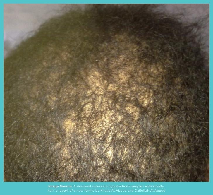 Woolly Hair Hypotrichosis
