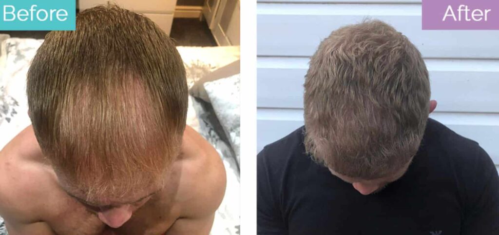 hair transplant young man
