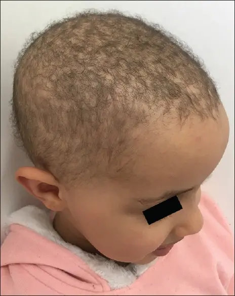 loose anagen syndrome 1