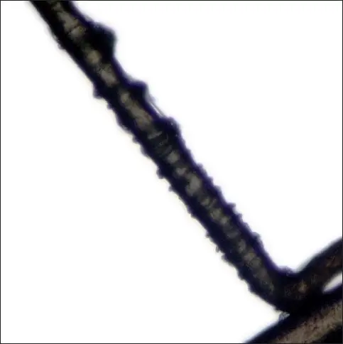 loose anagen syndrome 3