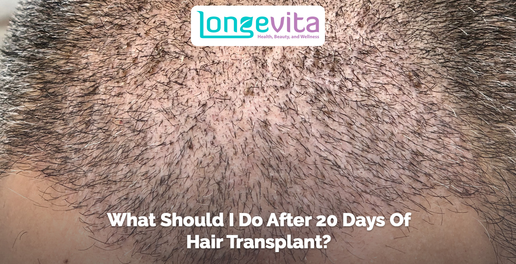 close-up of scalp 20 days after a hair transplant showing new hair growth