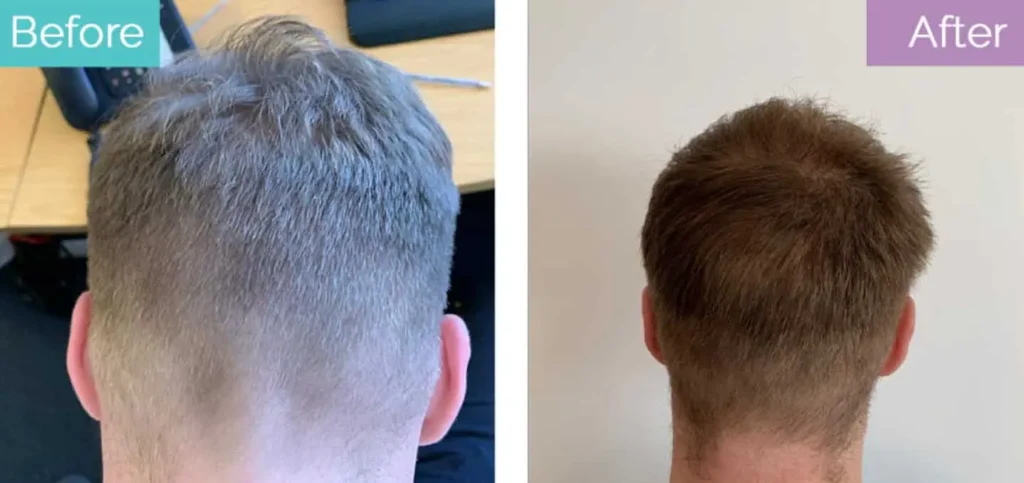 Donor area 6 month recovery