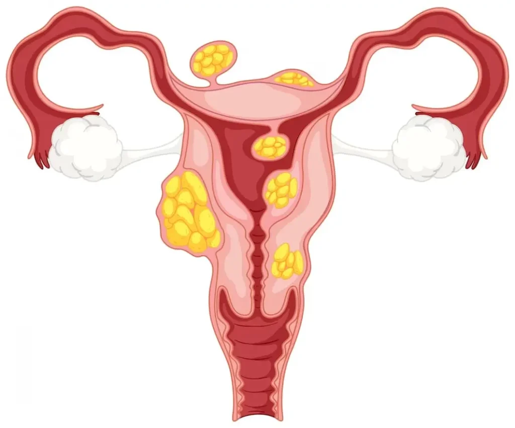 Uterine fibroids