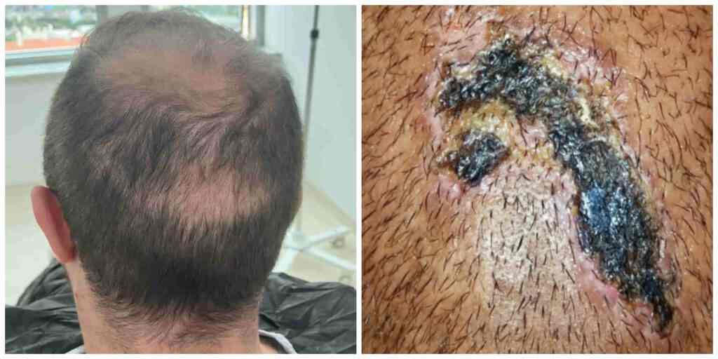 5,000 hair grafts complications