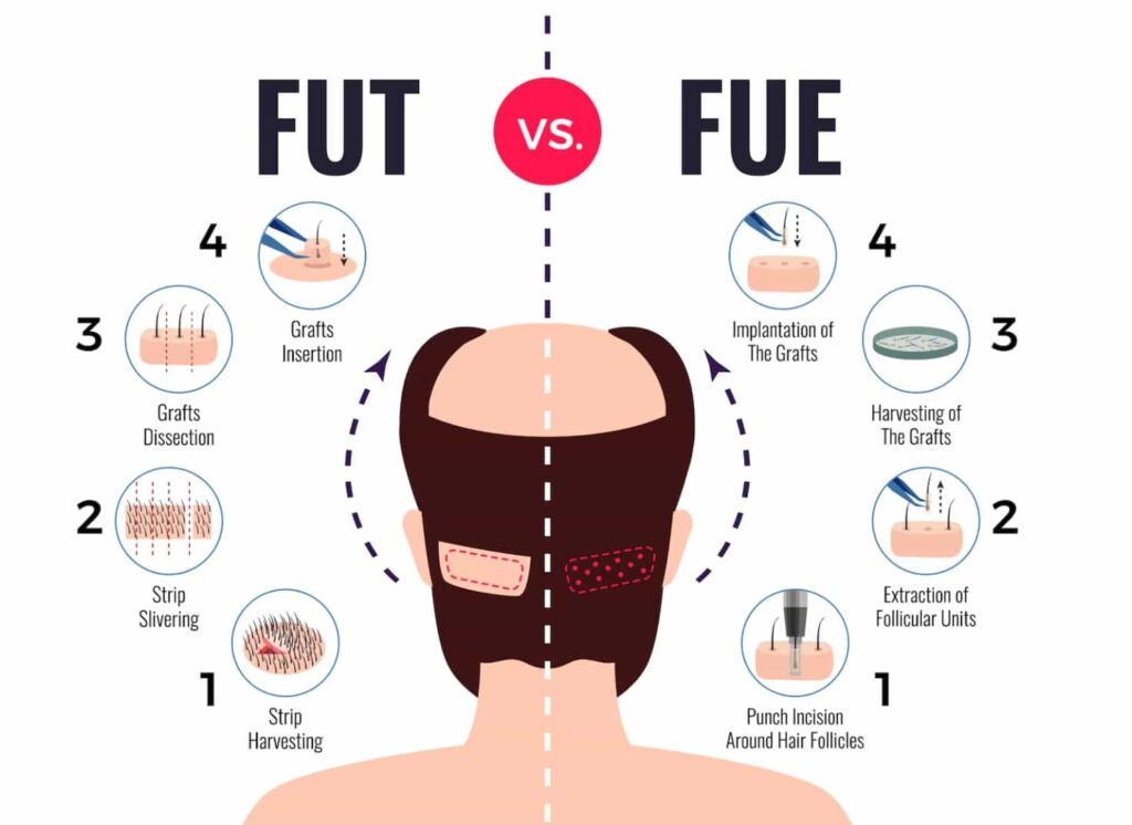Fut vs fue hair transplant