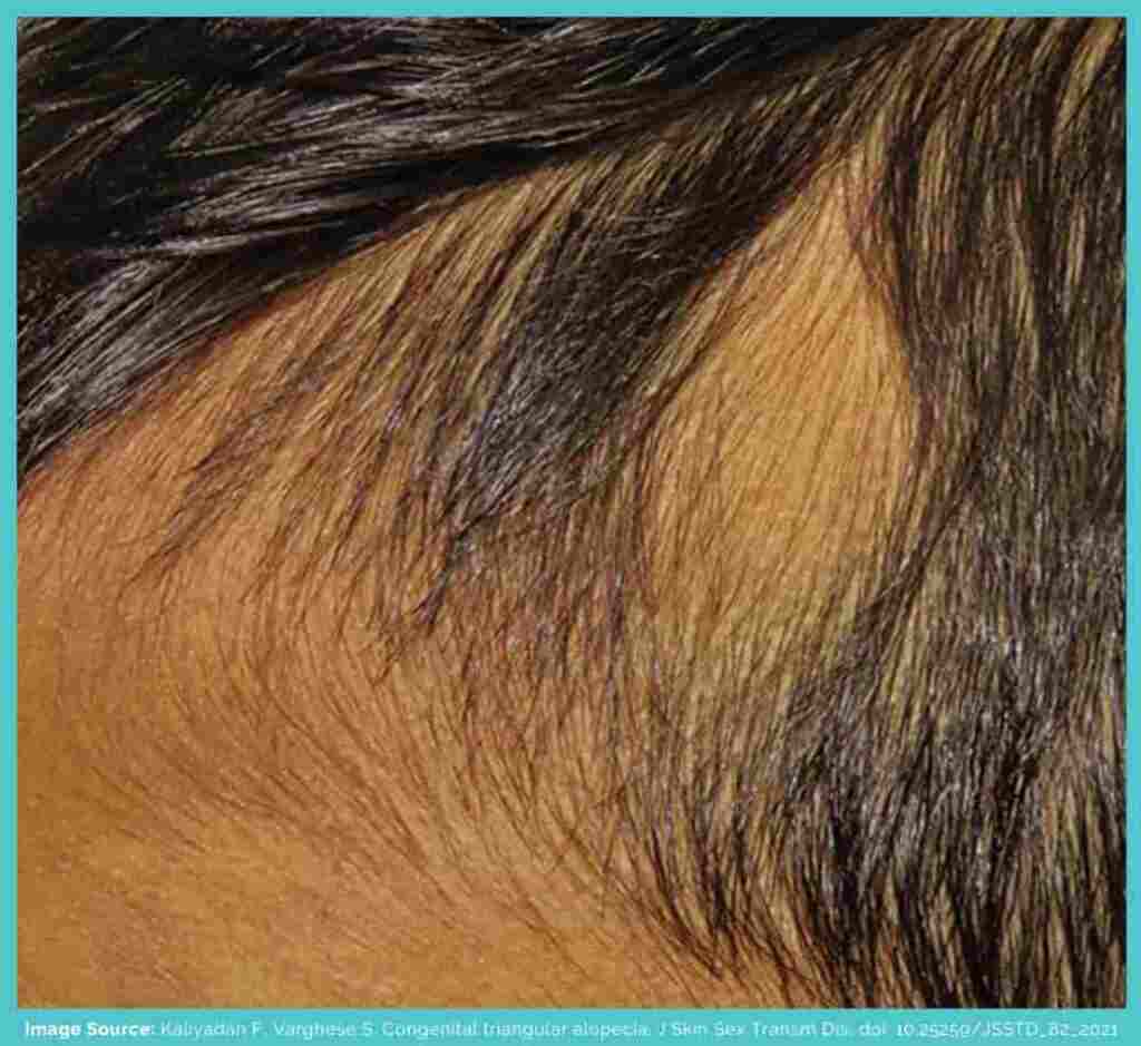 Male congenital triangular alopecia
