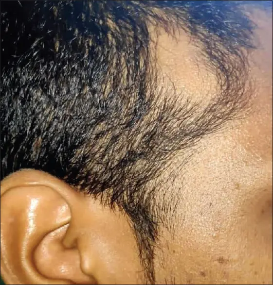 Triangular Alopecia