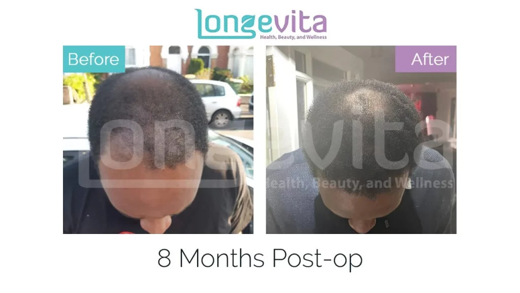 afro hair transplant turkey before after 8 1 1024x576