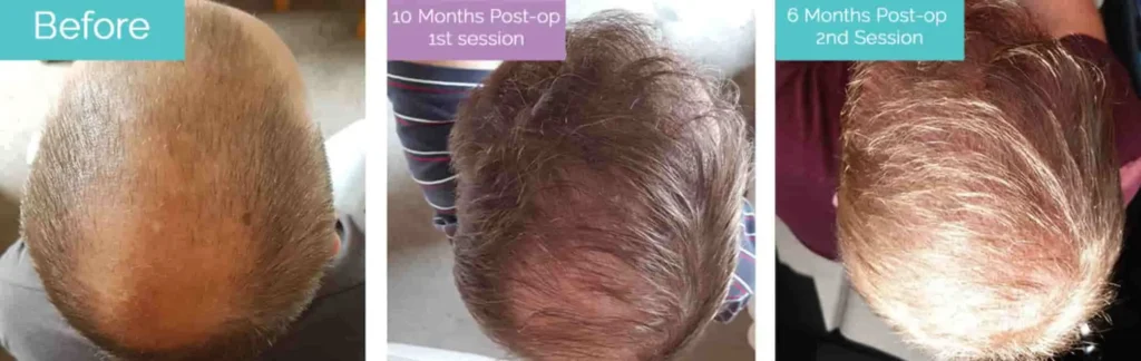 5000 hair grafts result