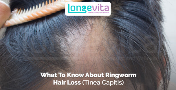 close-up of scalp with hair loss caused by ringworm infection