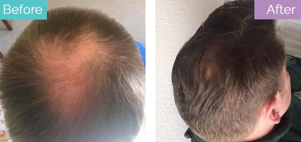 1000 grafts crown hair transplant