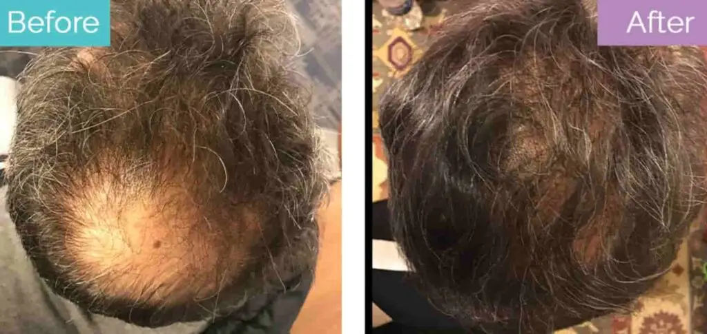 2000 grafts crown hair transplant