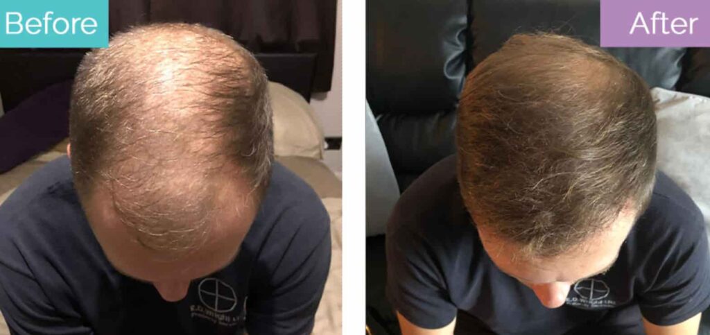 FUE Hair transplant before and after