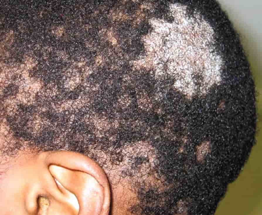 Grey patch hair loss