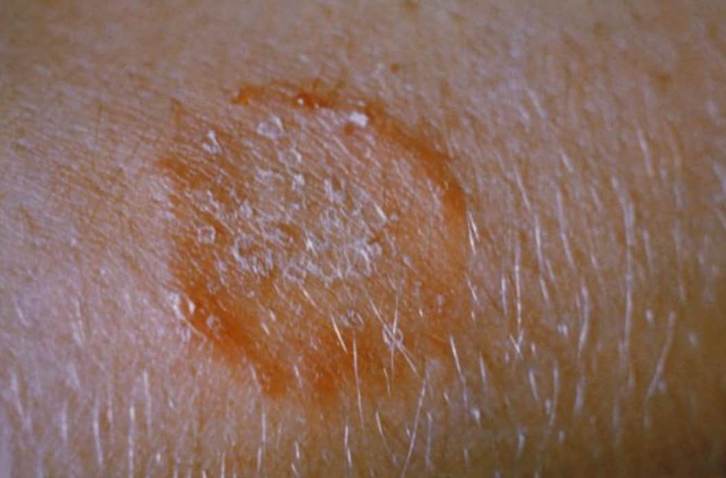 Ringworm Hair Loss: Signs, Causes & Treatments | Longevita