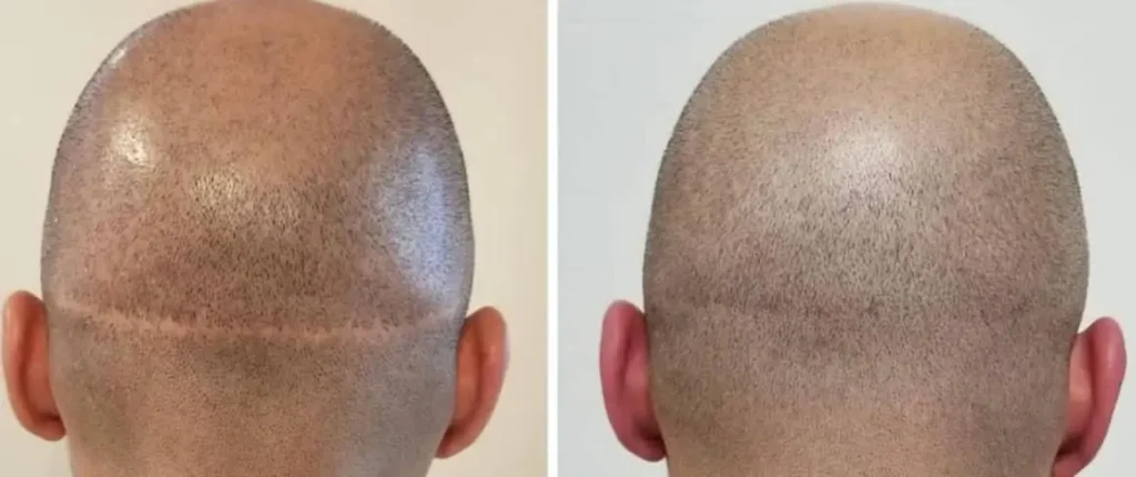FUT linear scar