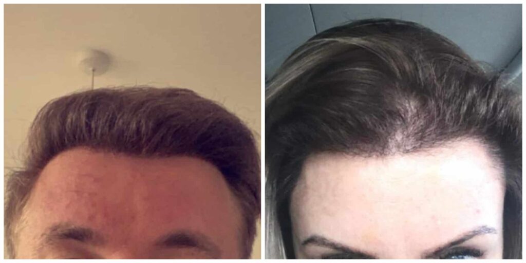 Male and female hairline