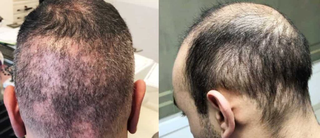 Poor hair transplant results (2)
