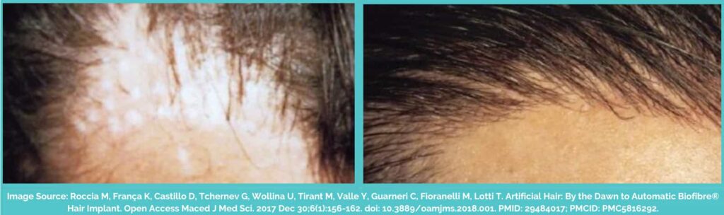 Synthetic hair transplant before and after