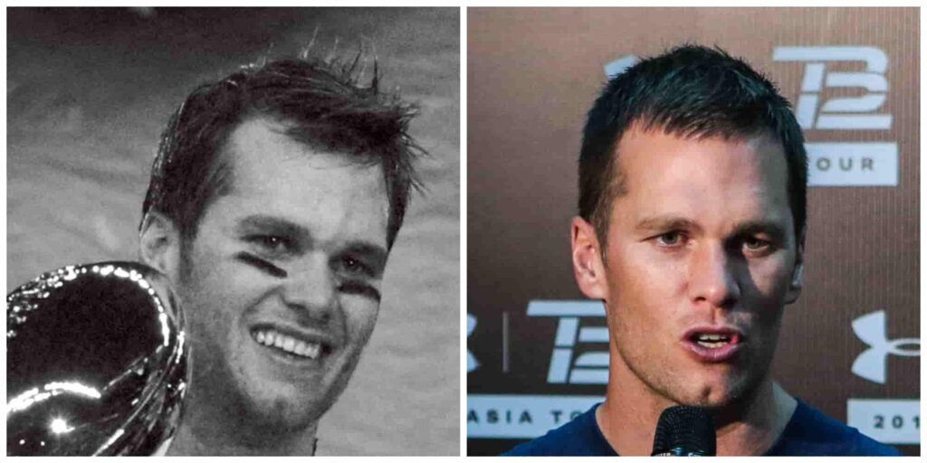 Tom Brady's hair before and after