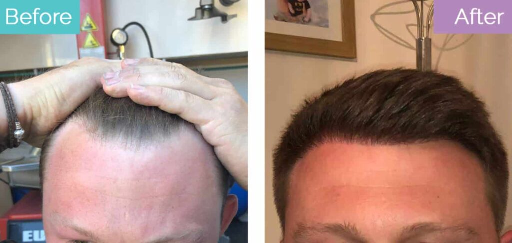 hairline lowering surgery male before and after