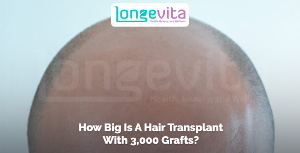3000-grafts-hair-transplant-coverage.jpg