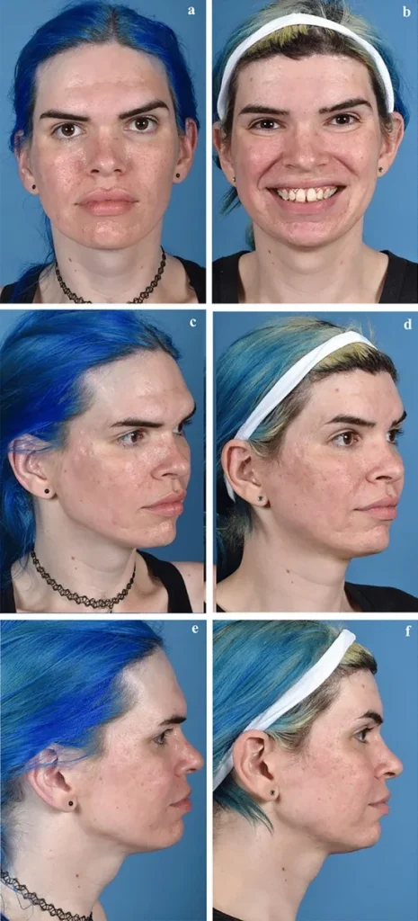 Hairline Lowering Surgery
