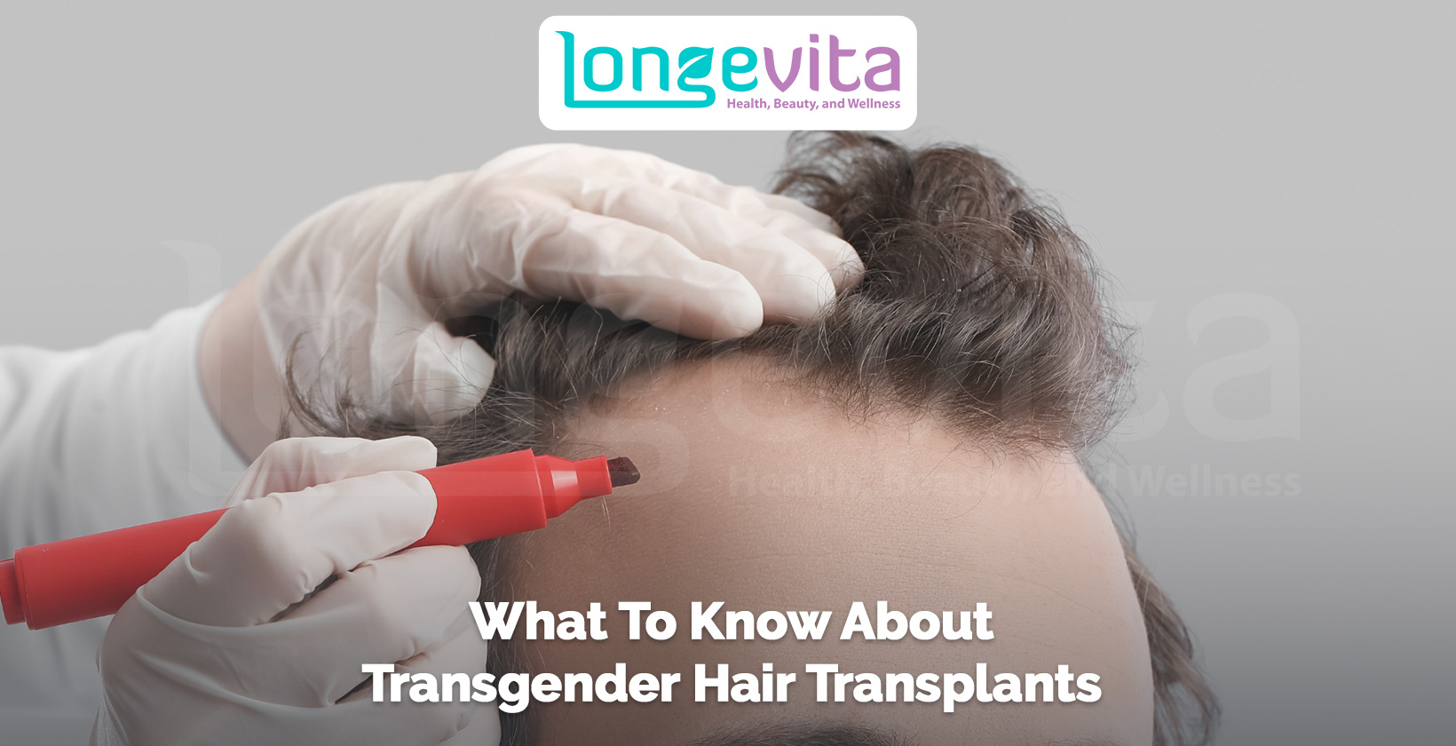 doctor marking hairline with red marker before transgender hair transplant